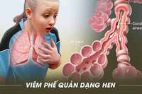 <a href="/benh-pho-bien/ho-hap/viem-phe-quan" title="Viêm phế quản" rel="dofollow">Viêm phế quản</a>