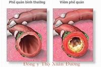 <a href="/benh-pho-bien/ho-hap/viem-phe-quan" title="Viêm phế quản" rel="dofollow">Viêm phế quản</a>