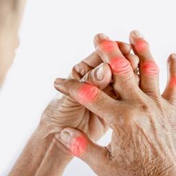 SKCĐ - Điều trị bằng Nam y: 3 tháng hết viêm khớp dạng thấp, 7 năm không tái bệnh