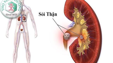 “Dắt túi" kinh nghiệm điều trị sỏi thận bằng Nam y