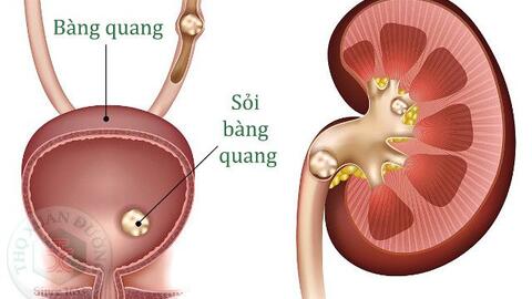 NGL-Kỳ 14: Sỏi tiết niệu có thể dẫn đến suy thận, thậm chí tử vong nếu điều trị chậm trễ và sai cách