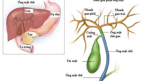 Tổng quan về ung thư túi mật và đường mật