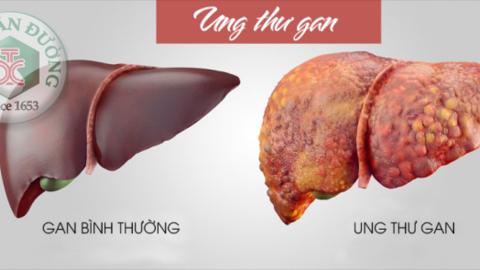 Những nguyên nhân dẫn đến ung thư gan