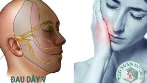 Điều trị đau dây V bằng châm cứu