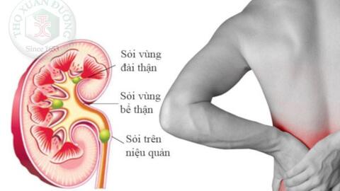 Biến chứng nguy hiểm của sỏi tiết niệu