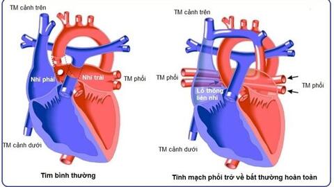 Các bệnh tim bẩm sinh thường gặp