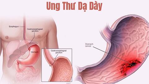 SKCĐ - Khống chế ung thư dạ dày bằng đông tây y kết hợp