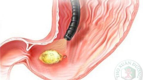 Các phương pháp điều trị ung thư dạ dày hiện nay