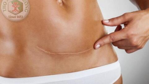 Vết mổ đẻ và những vấn đề cần quan tâm