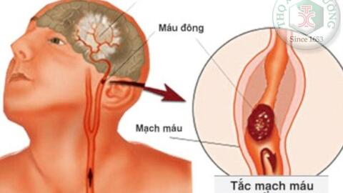 Cách phòng ngừa thiểu năng tuần hoàn não