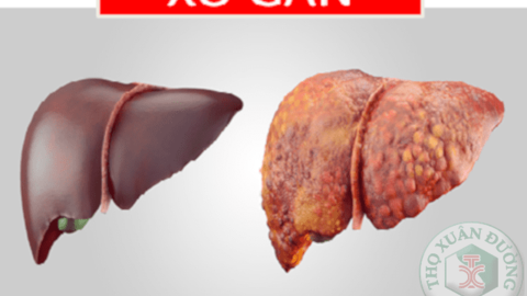Độ xơ hóa gan F0 – F4 là như thế nào?
