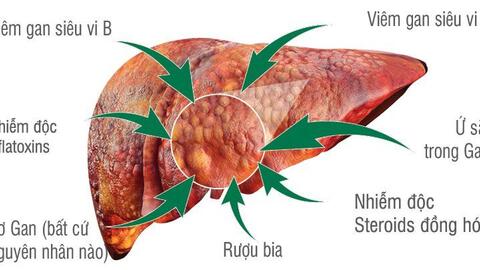 Dấu hiệu nhận biết ung thư gan nguyên phát 