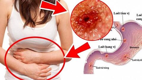 Những yếu tố nguy cơ hàng đầu gây ung thư dạ dày 