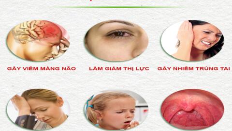 Biến chứng nguy hiểm của viêm xoang không nên chủ quan