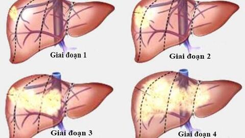 Các giai đoạn của bệnh ung thư gan
