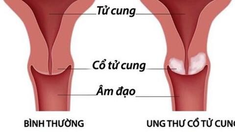 Những đối tượng có nguy cơ cao mắc bệnh ung thư cổ tử cung 