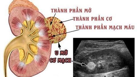 U cơ mỡ mạch thận là gì, có nguy hiểm không ?