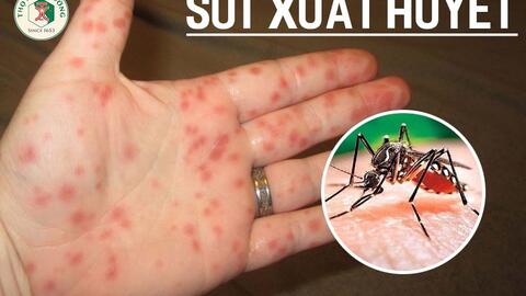 Sốt xuất huyết theo y học cổ truyền