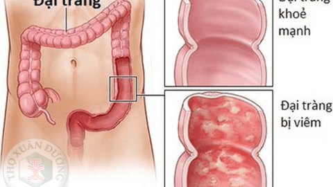 Biến chứng đáng sợ của viêm loét đại trực tràng chảy máu thường gặp