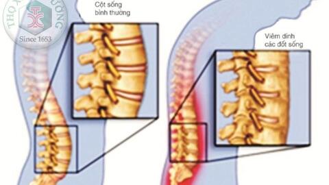 Biểu hiện tại khớp của bệnh viêm cột sống dính khớp
