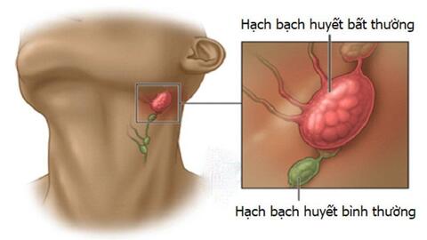 Điểm qua một số cây thuốc nam chữa bệnh ung thư hạch bạch huyết