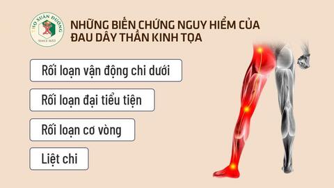Những biến chứng nguy hiểm của đau dây thần kinh tọa mà bạn nên biết