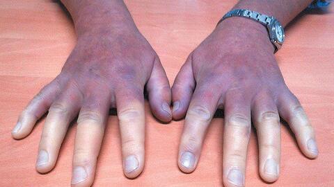 Hội chứng Raynaud trong xơ cứng bì 