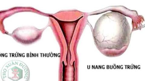Các loại u nang buồng trứng hay gặp
