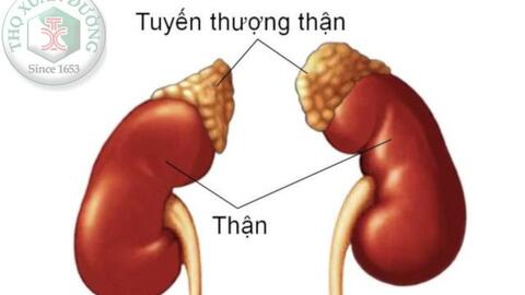 Các loại u tuyến thượng thận thường gặp