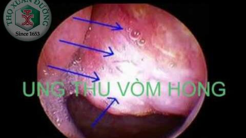 Các phương pháp điều trị ung thư vòm họng