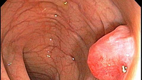 Polyp đại trực tràng chớ coi thường