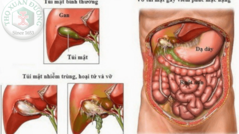Dấu hiệu nhận biết nhiễm trùng đường mật