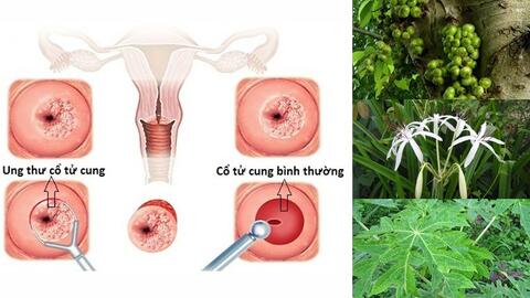Tìm hiểu một số bài thuốc dân gian trị bệnh ung thư cổ tử cung