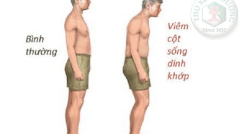 Dùng châm cứu kết hợp tác động cột sống điều trị viêm cột sống dính khớp
