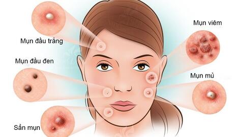 Nguyên nhân gây ra mụn trứng cá 