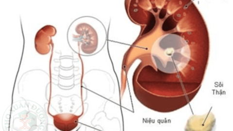 Mẹo nhỏ chữa sỏi thận tại nhà
