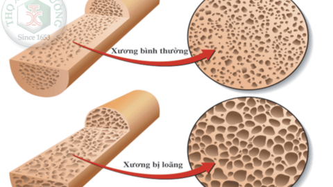 Nguyên nhân gây loãng xương ít người biết