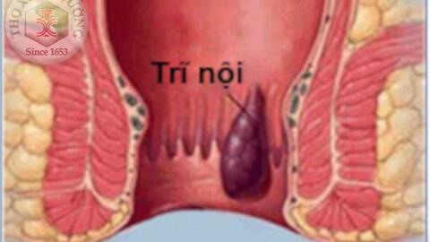 Nguyên nhân gây bệnh trĩ không phải ai cũng biết
