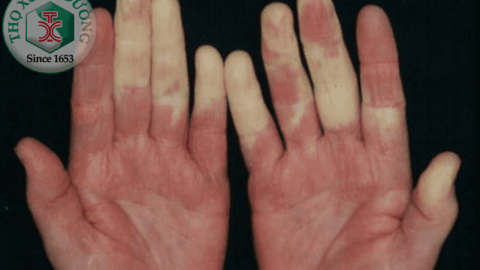 Thời tiết chuyển lạnh khiến bệnh nhân mắc hội chứng Raynaud khổ sở