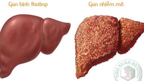 Thế nào là bệnh lý gan nhiễm mỡ không do rượu?