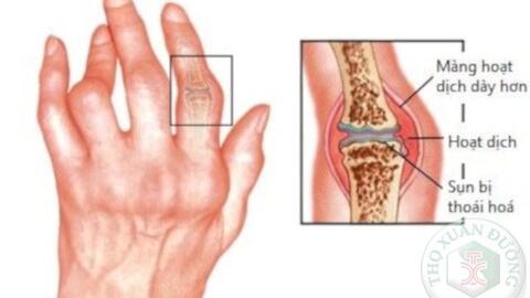 Tiêu chuẩn chẩn đoán viêm khớp dạng thấp