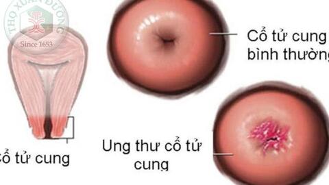 Triệu chứng ung thư cổ tử cung