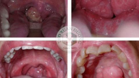 Xạ trị ung thư vòm họng và tác dụng phụ cần biết