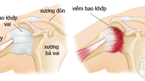 Viêm quanh khớp vai