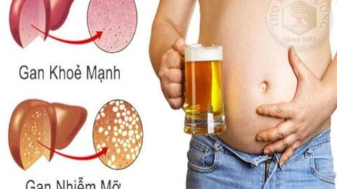 Gan nhiễm mỡ có mấy giai đoạn?