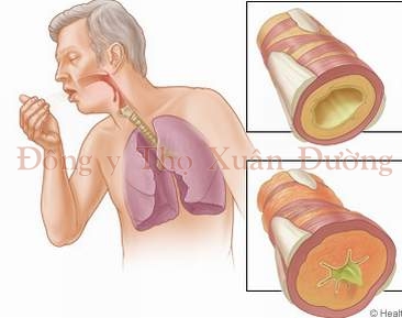 chữa hen phế quản, chữa hen, chua hen, Châm cứu chữa hen phế quản 