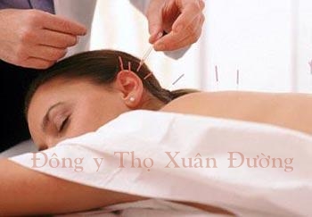 chua mat ngu, chữa mất ngủ, Châm cứu bấm huyệt trị liệu chữa mất ngủ