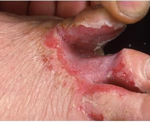 nấm chân, chữa nấm chân, chua nam chan, Đông y chữa Nấm chân